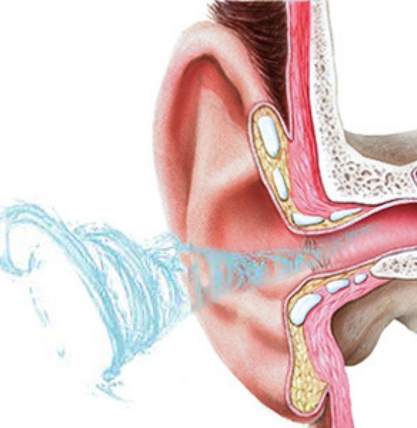 Ear Washer and Ear Irrigation Kit: image 6